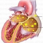atrial-fibrilasyon-150x150